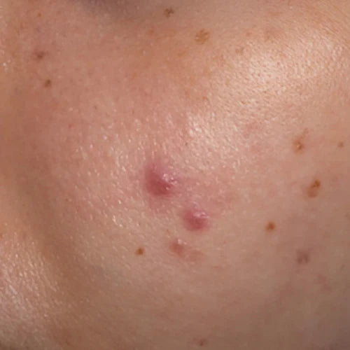 Acne/Pimple